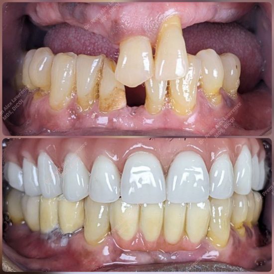 before-after-all-on-four-implants